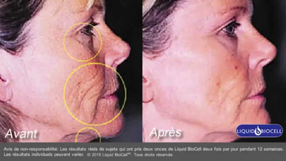 Verisol Before After